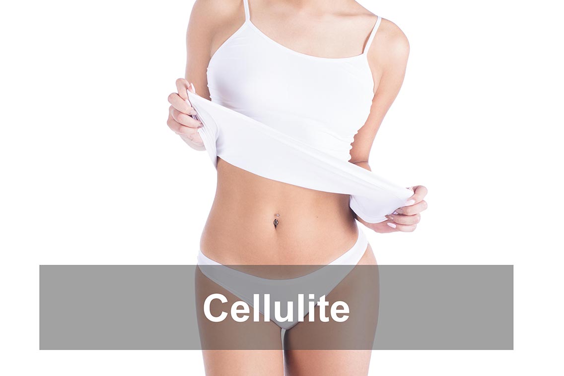 cellulite-relachement-cutane
