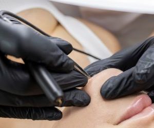 Épilation Laser du Visage : Tout ce que Vous Devez Savoir