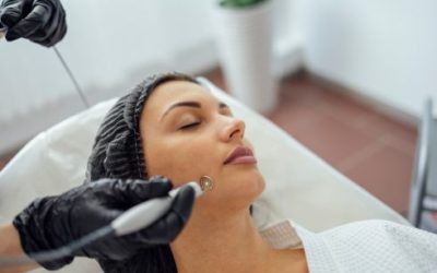 Cicatrices d’acné et cicatrices profondes : comment le laser améliore vraiment la peau